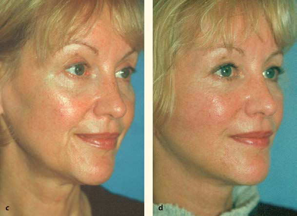 Facelift and necklift giving a beautiful result; Surgery by Dr. BCK Patel MD, FRCS, Salt Lake City, Patel Plastic Surgery