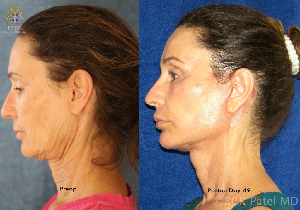 Facelift and Neck Lift by Dr. BCK Patel MD, FRCS of Salt Lake City and St George Utah and of Patel Plastic Surgery in a male